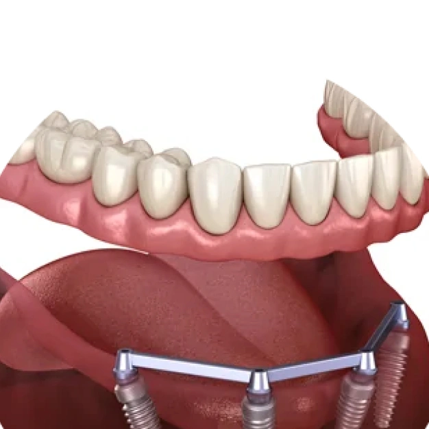 New Dentures for patient at SmileCare Dental